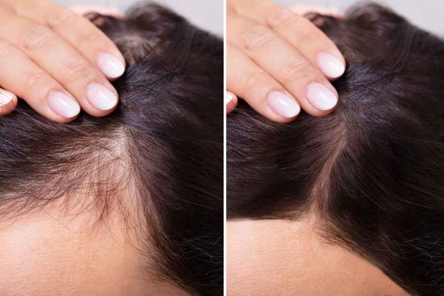 Read more about the article 3 Unbeatable Ways to Stop Hair Loss Naturally
